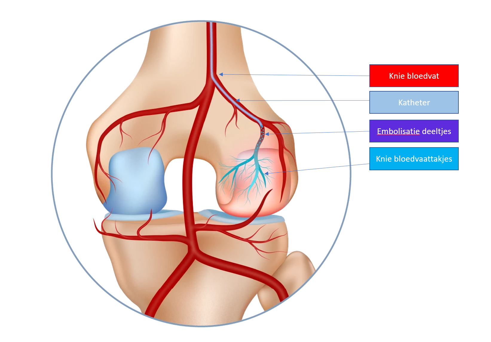 Knie embolisatie